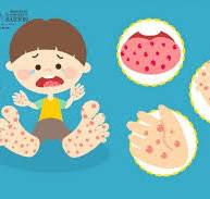 Các biện pháp phòng chống dịch bệnh Tay -Chân- Miệng cho trẻ Mầm non